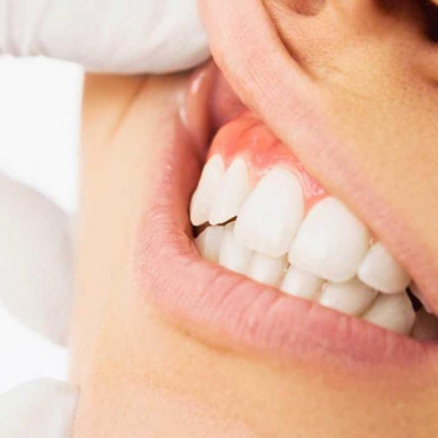 Набрякли ясна після лікування зуба